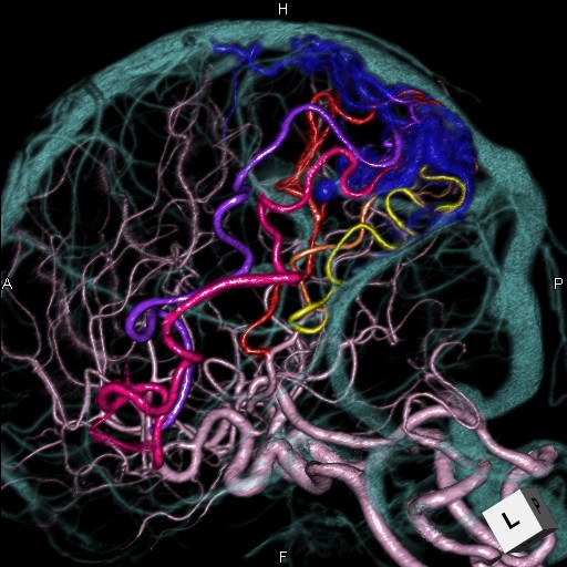 脳動静脈奇形の3Dモデル