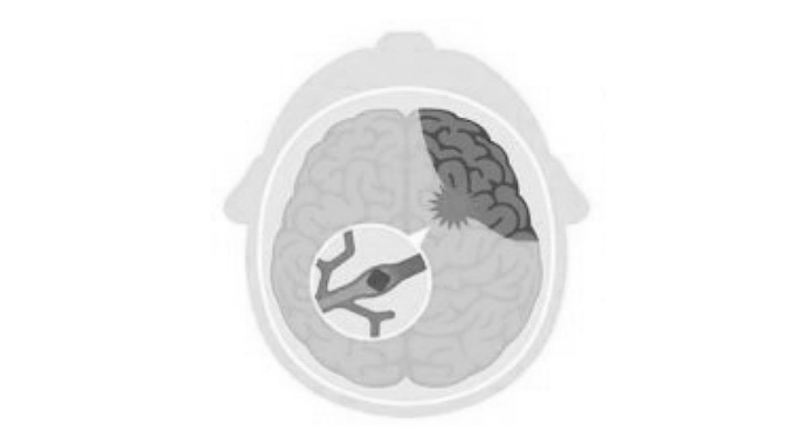 脳動脈閉鎖症・もやもや病