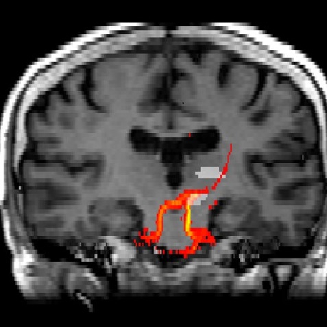 Probabilistic Tractographyによる歯状核-赤核-視床路の解析