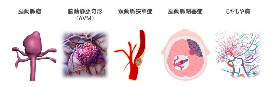 脳動脈瘤 、脳動静脈奇形（AVM） 、頚動脈狭窄症 、脳動脈閉塞症 、もやもや病のイメージ画像