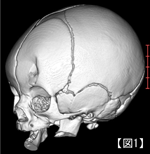 子どもの頭部CT