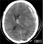 急性硬膜下血腫のCT