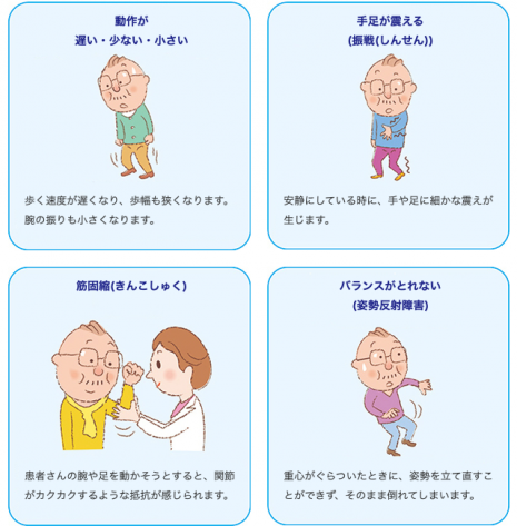 パーキンソン病の主な症状