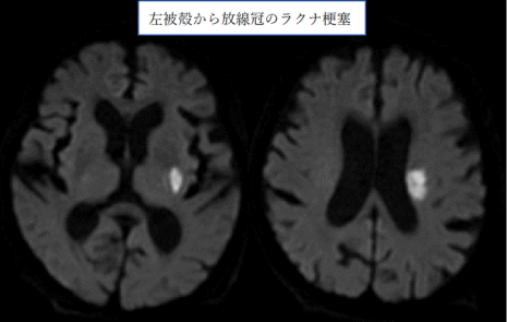 左被殻から放線冠のラクナ梗塞