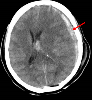 急性硬膜下血腫のCT画像