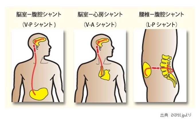 iNPHの治療方法