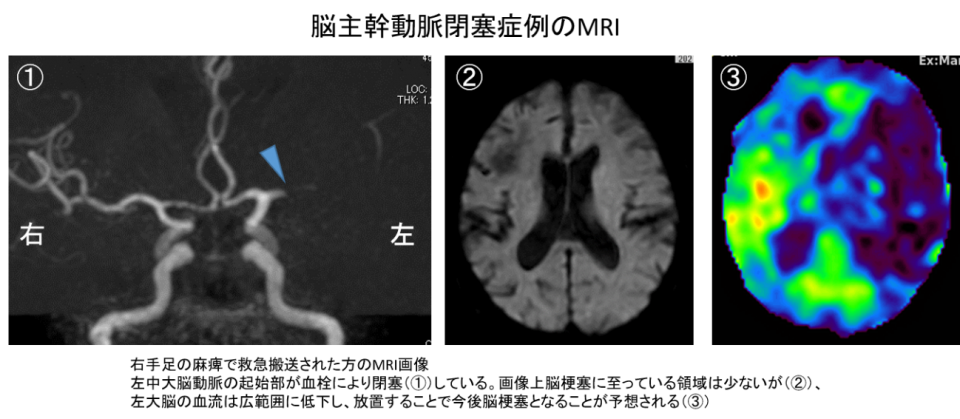 脳主幹動脈閉塞症例のMRI