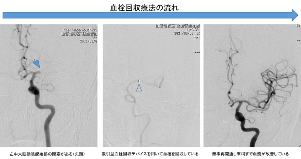 血栓回収療法の流れ