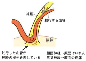 神経、蛇行する血管、脳幹。蛇行した血管が神経の根本を推している。顔面神経、顔面けいれん。三叉神経、顔面の疼痛