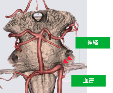 血管が神経をおしている