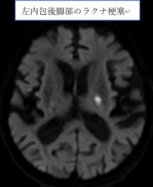 左内包後脚部のラクナ梗塞