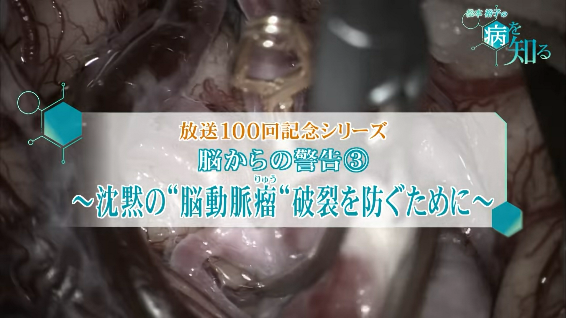 UHBテレビ番組「松本裕子の病を知る」放送100回記念シリーズ　「脳からの警告③　沈黙の脳動脈瘤・・・破裂を防ぐために」に当院が紹介されました