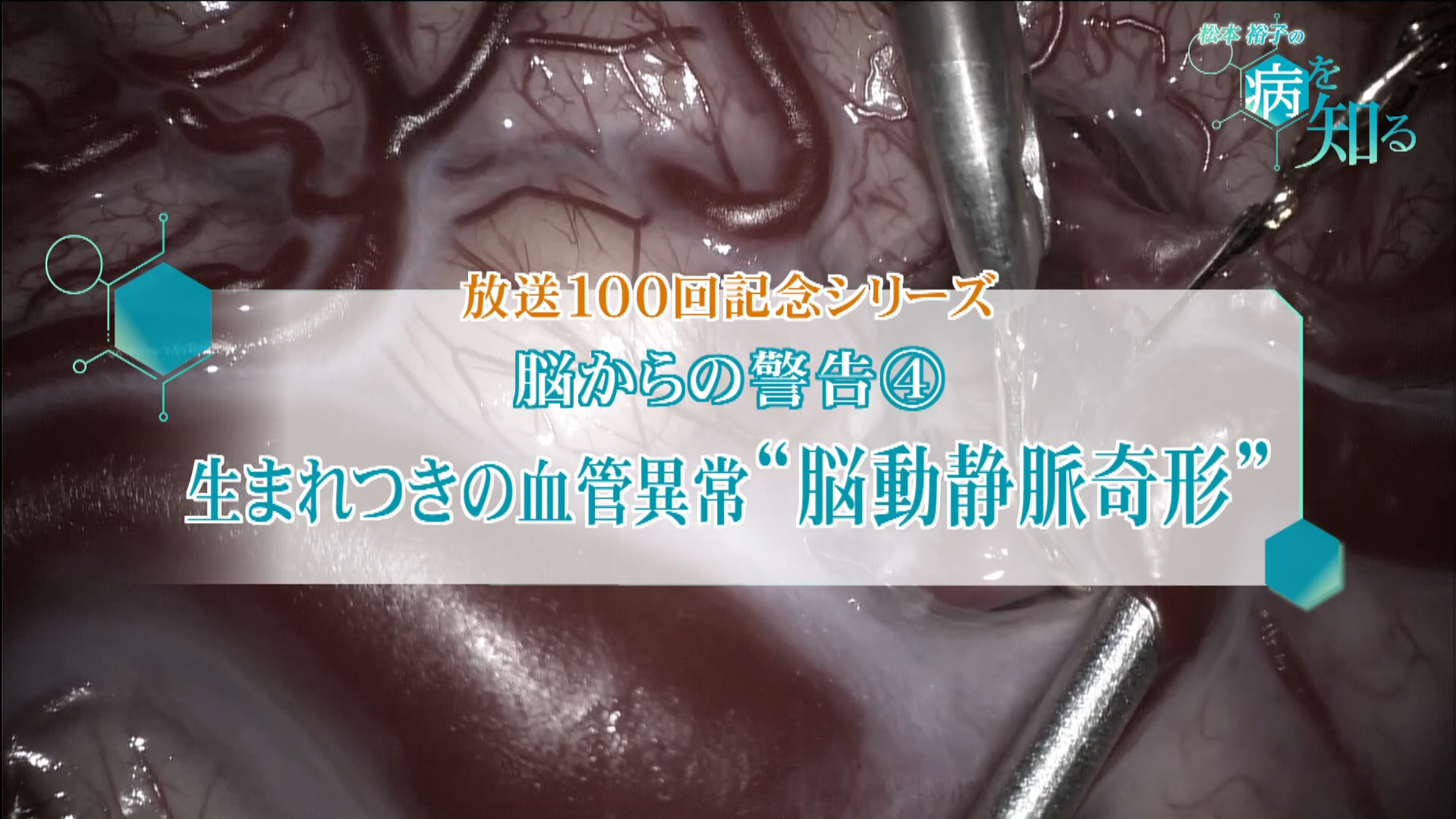 UHBテレビ番組「松本裕子の病を知る」放送100回記念シリーズ　「脳からの警告④　生まれつきの血管異常・・・”脳動静脈奇形”とは」に当院が紹介されました
